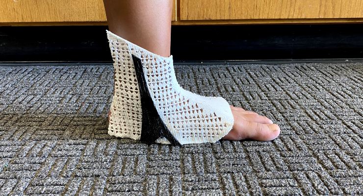 3D-printed ankle brace on a foot