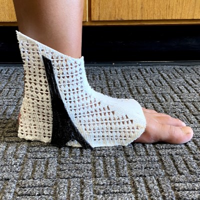 3D-printed ankle brace on a foot